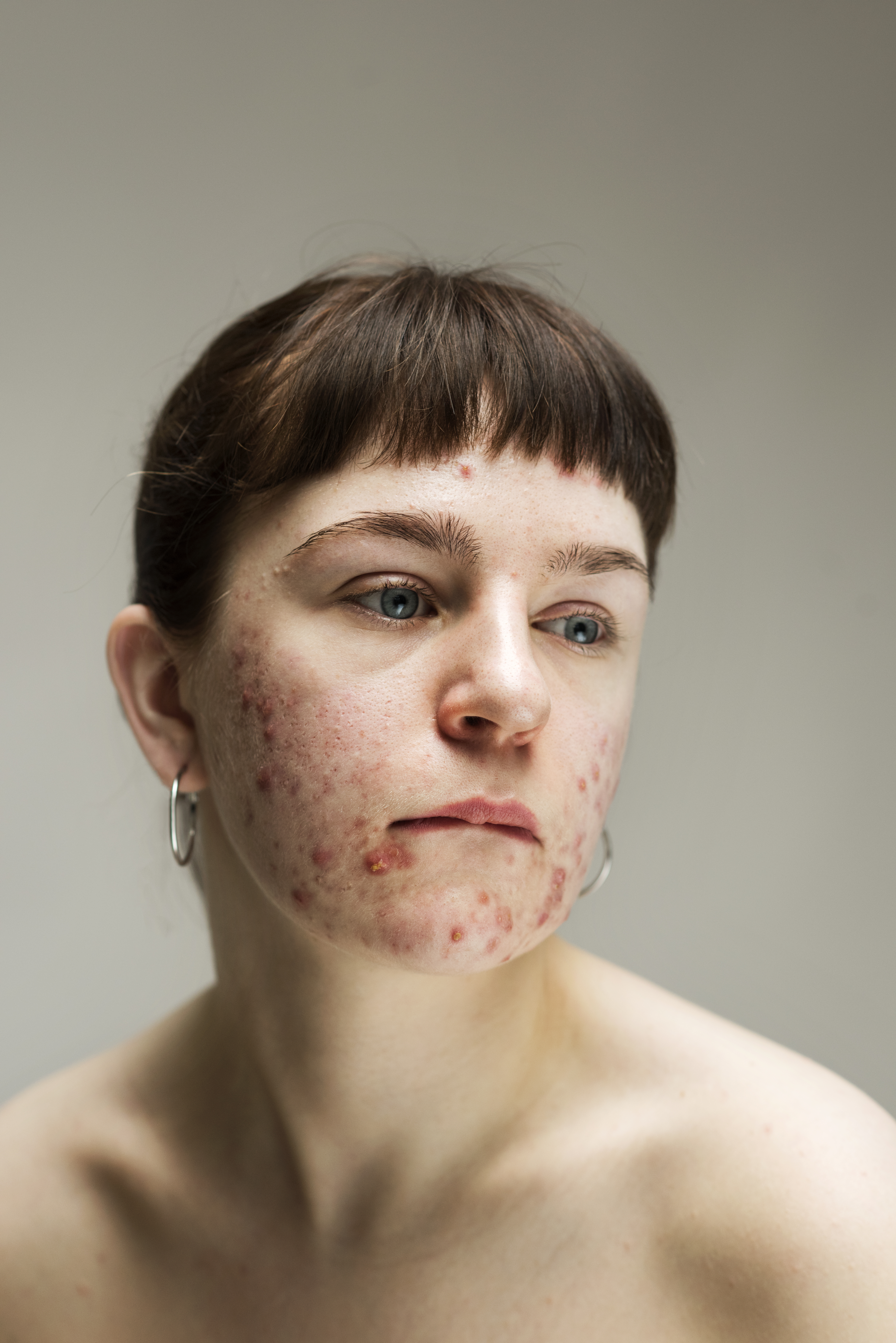 fotoserie huidaandoeningen sophie harris taylor