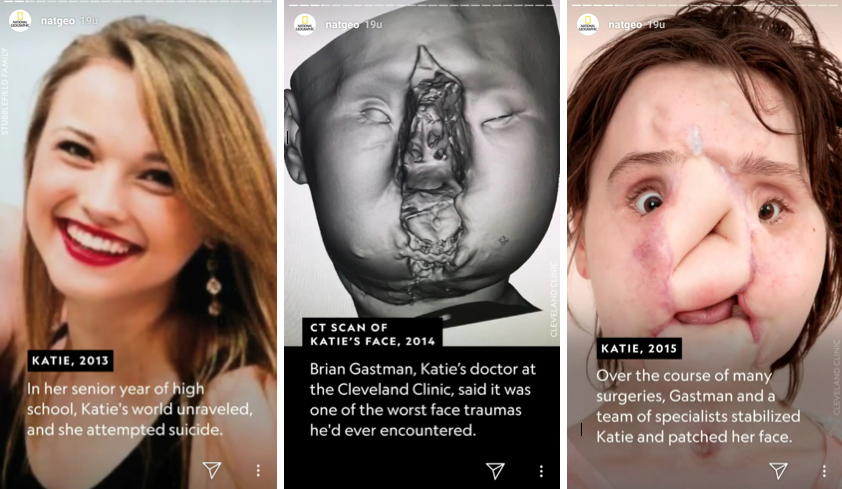 Katie gezichtstransplantatie