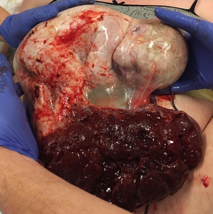 Geboorte in de vliezen - placenta