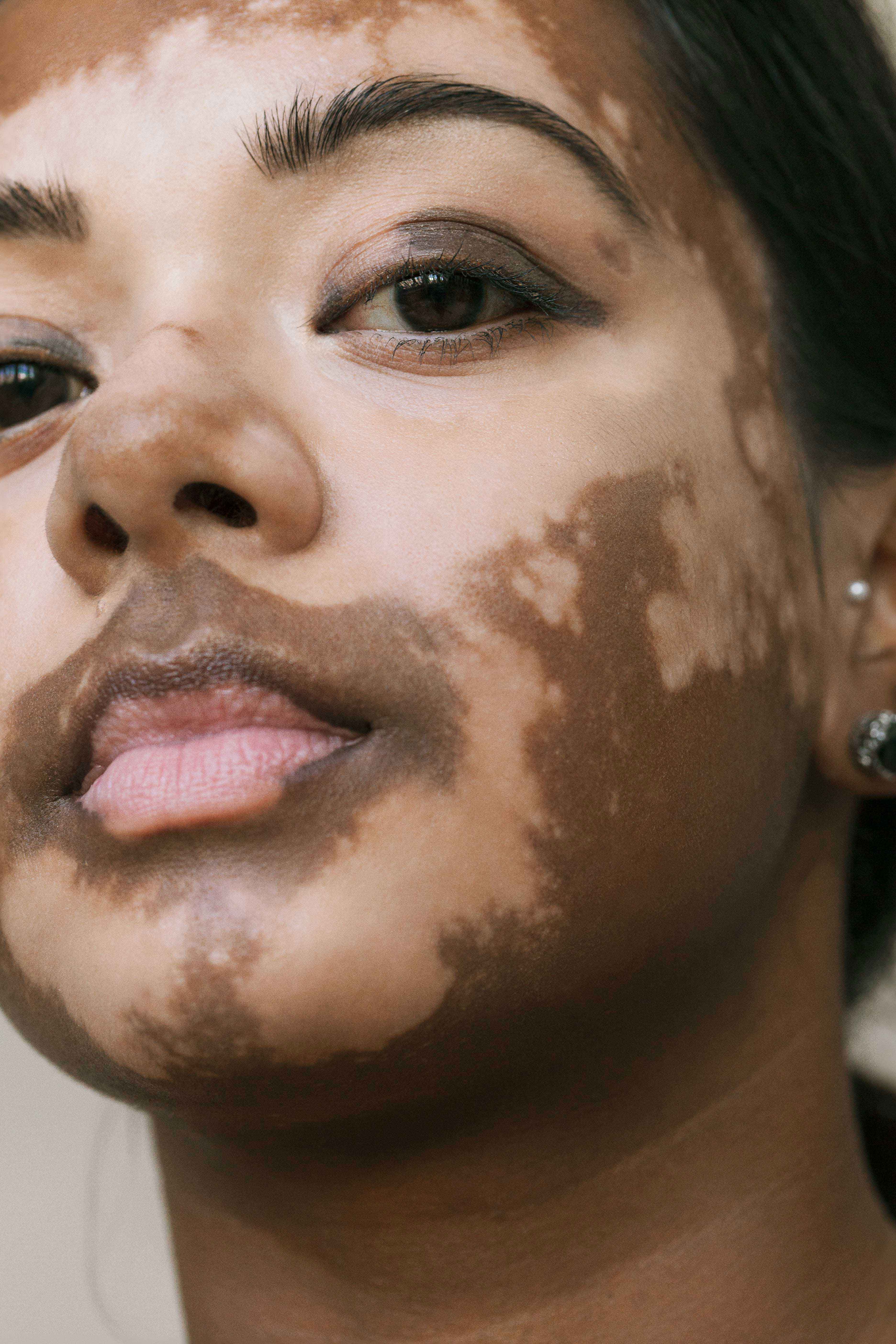 Sharista_Elisabeth-van-Aalderen_vitiligo_3