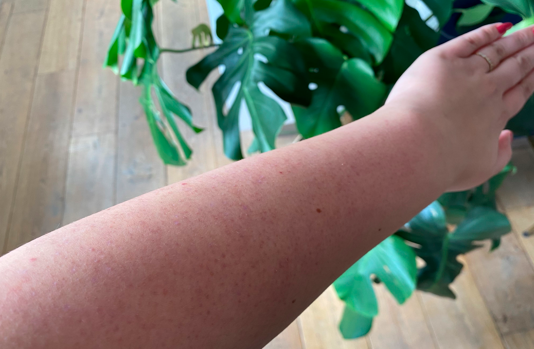 Last van rode, bobbelige huid? Het is keratosis pilaris, zó ga je het