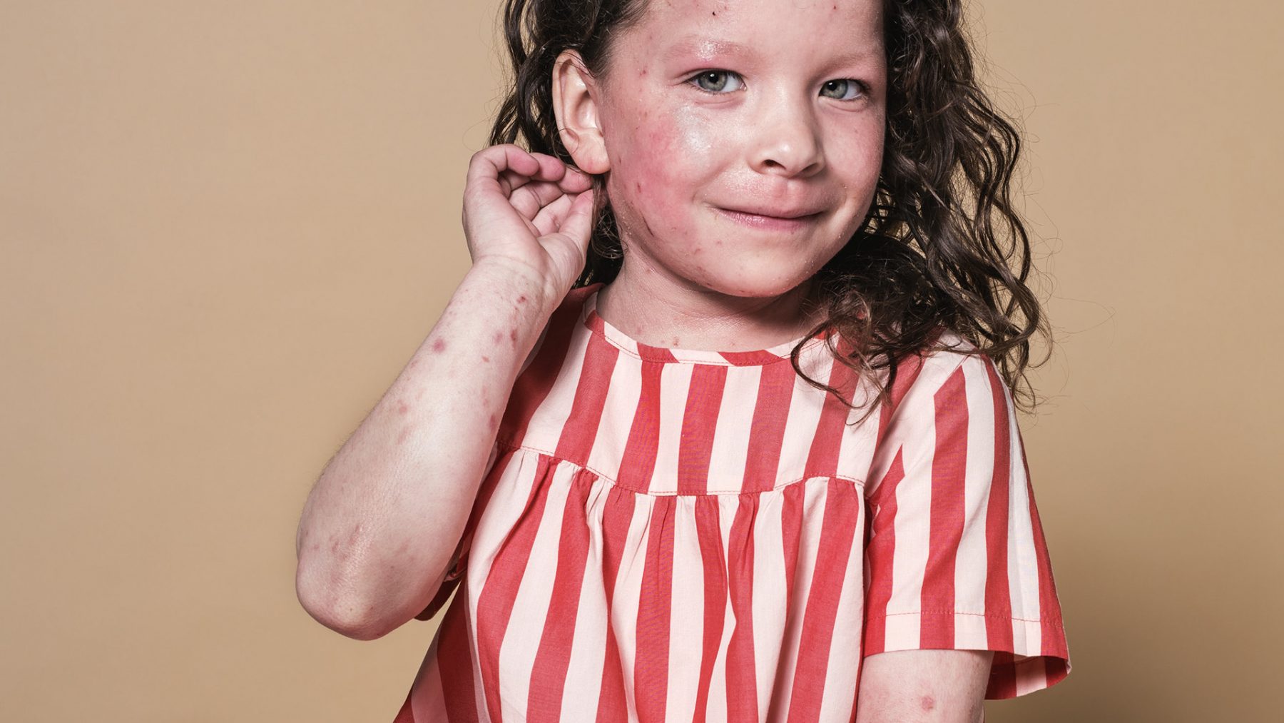 Elyssa (6)heeft eczeem: 'Ze verdraagt geen crèmes en gilt van de pijn'
