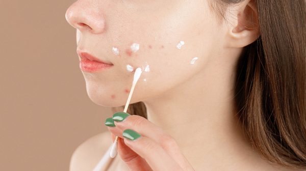 Onderzoek toont verband tussen acne en omega 3-vetzuren