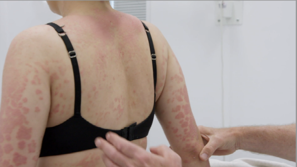 Heftige psoriasis in 'Mijn huid ziet er niet uit': 'Je wordt als een melaatse behandeld'
