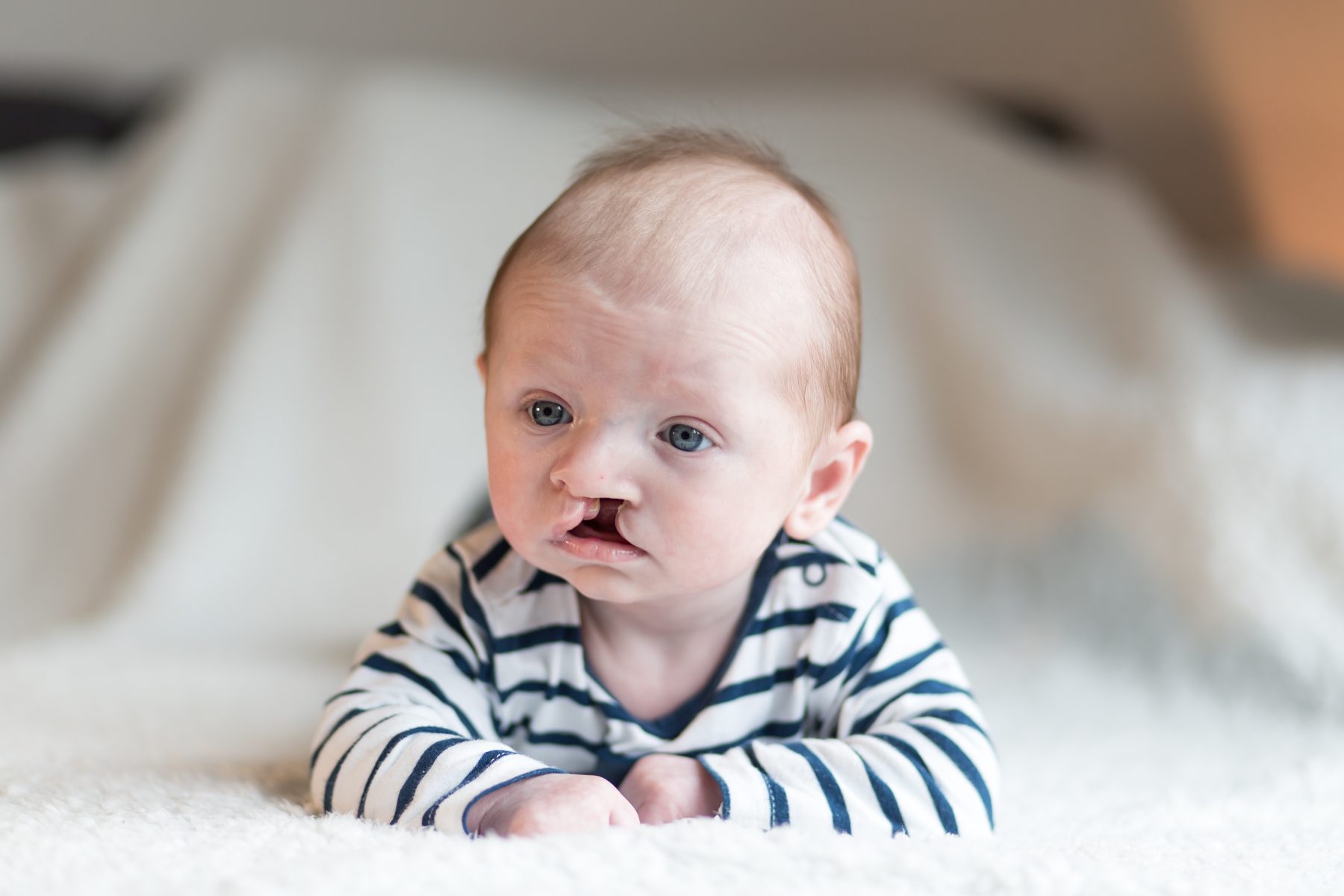 Debbie's zoontje heeft schisis 'Het is veel meer dan een hazenlip