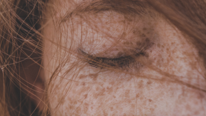 Spot thumbnail here, freckle there: Here's what a dermatologist says about pigment spots