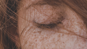 Thumbnail for Spot here, freckle there: here's what the dermatologist says about pigment spots