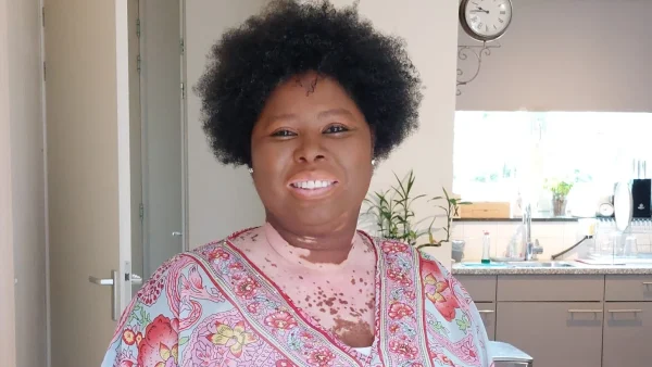 Annie, 55, has Vitiligo: She is not innocent