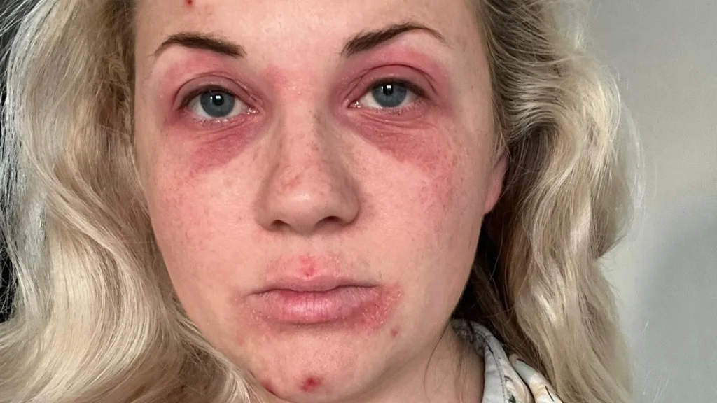 Heleen (30) heeft eczeem-uitbraken door hooikoorts: 'Mensen denken als snel dat het vies is'