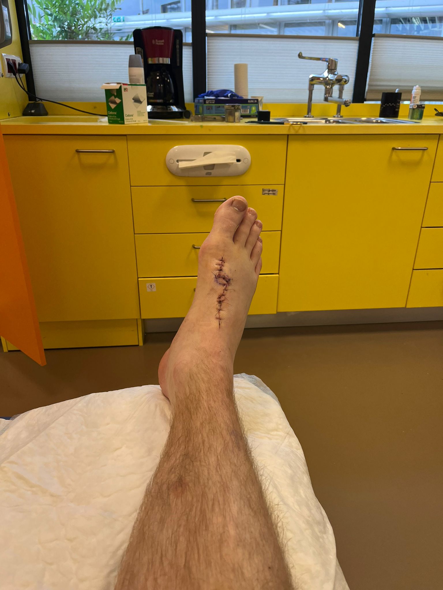 voet na operatie
