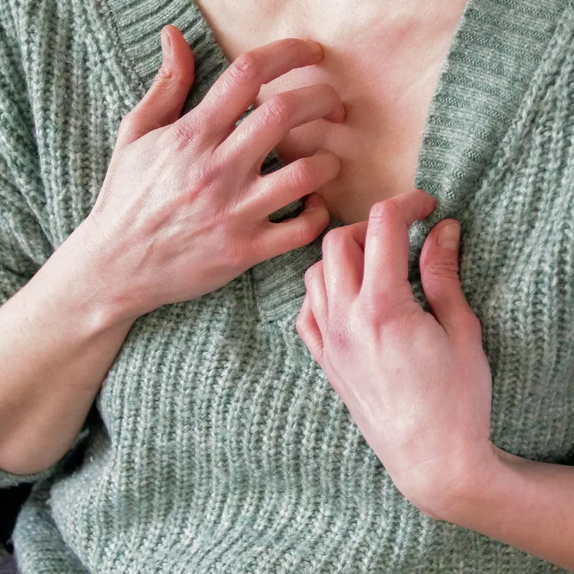 Sanne gaf haar schoonmoeder schurft: Deed alsof neus bloedde