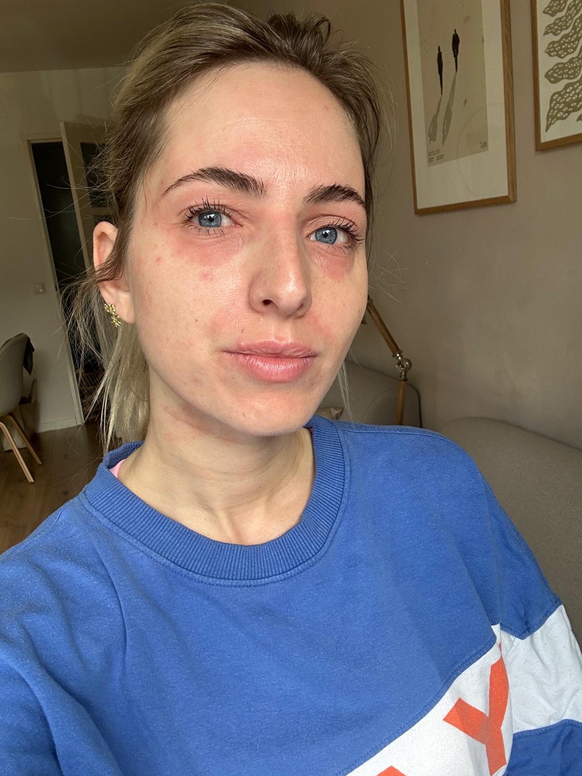 Eline de Ruig had jarenlang last van heftige allergische reacties ...