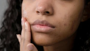 Thumbnail voor Alles over puistjes: via deze WhatsApp-hulplijn kun je ál je acne-vragen stellen