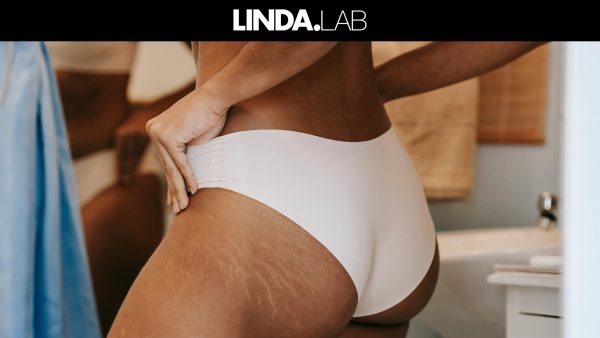 striae vrouw verminderen serum