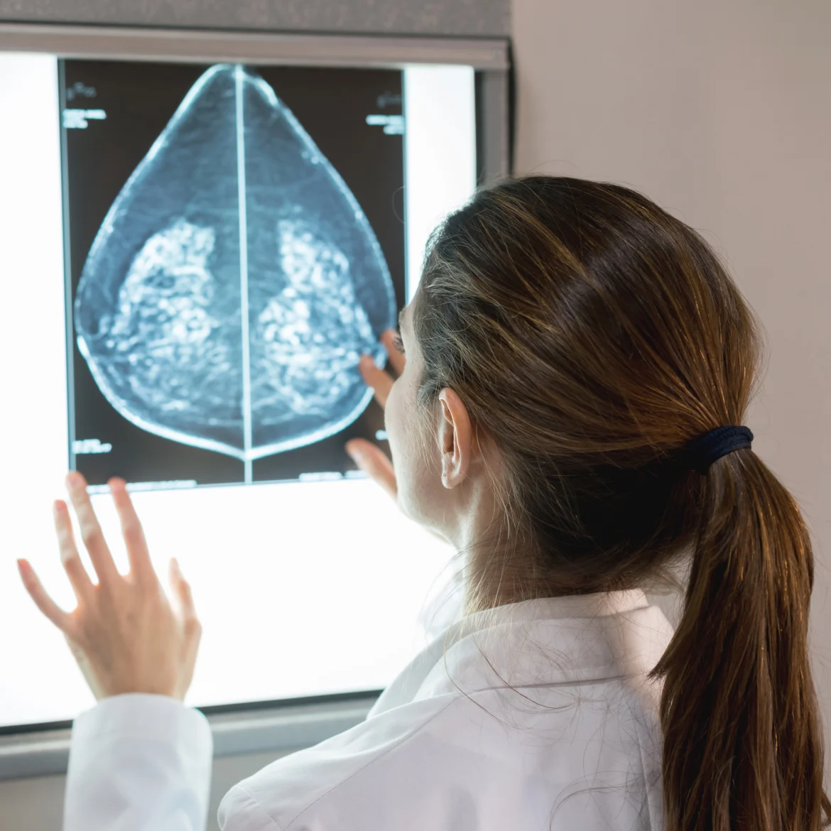 jonge vrouwen kanker mammoscan borstkanker