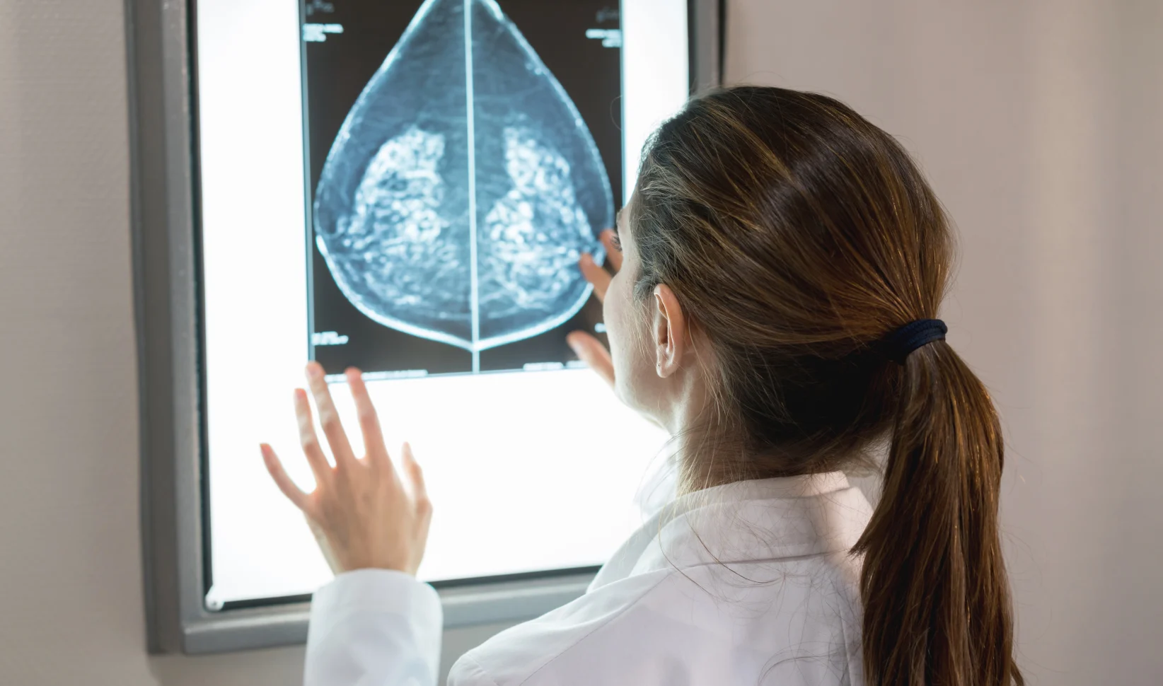 jonge vrouwen kanker mammoscan borstkanker