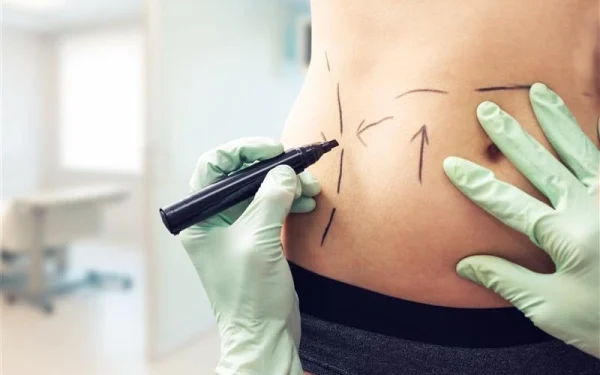 Vrouw (47) sterft na liposuctie, 1 op de 4 klinieken in Italië werkt illegaal