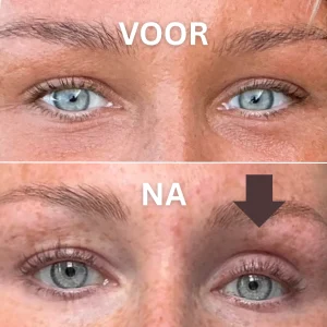 voor, en, na, Luca