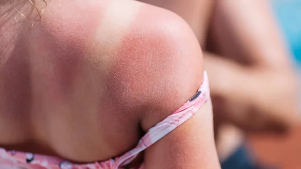 Rug verbrand van kind | Ruggetjes