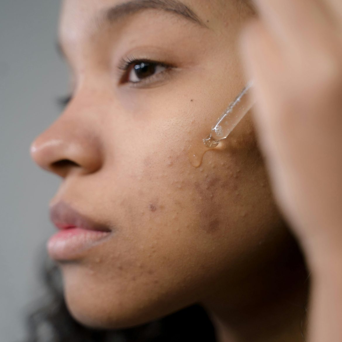 hormonale, acne, vrouw, jetske ultee, tips