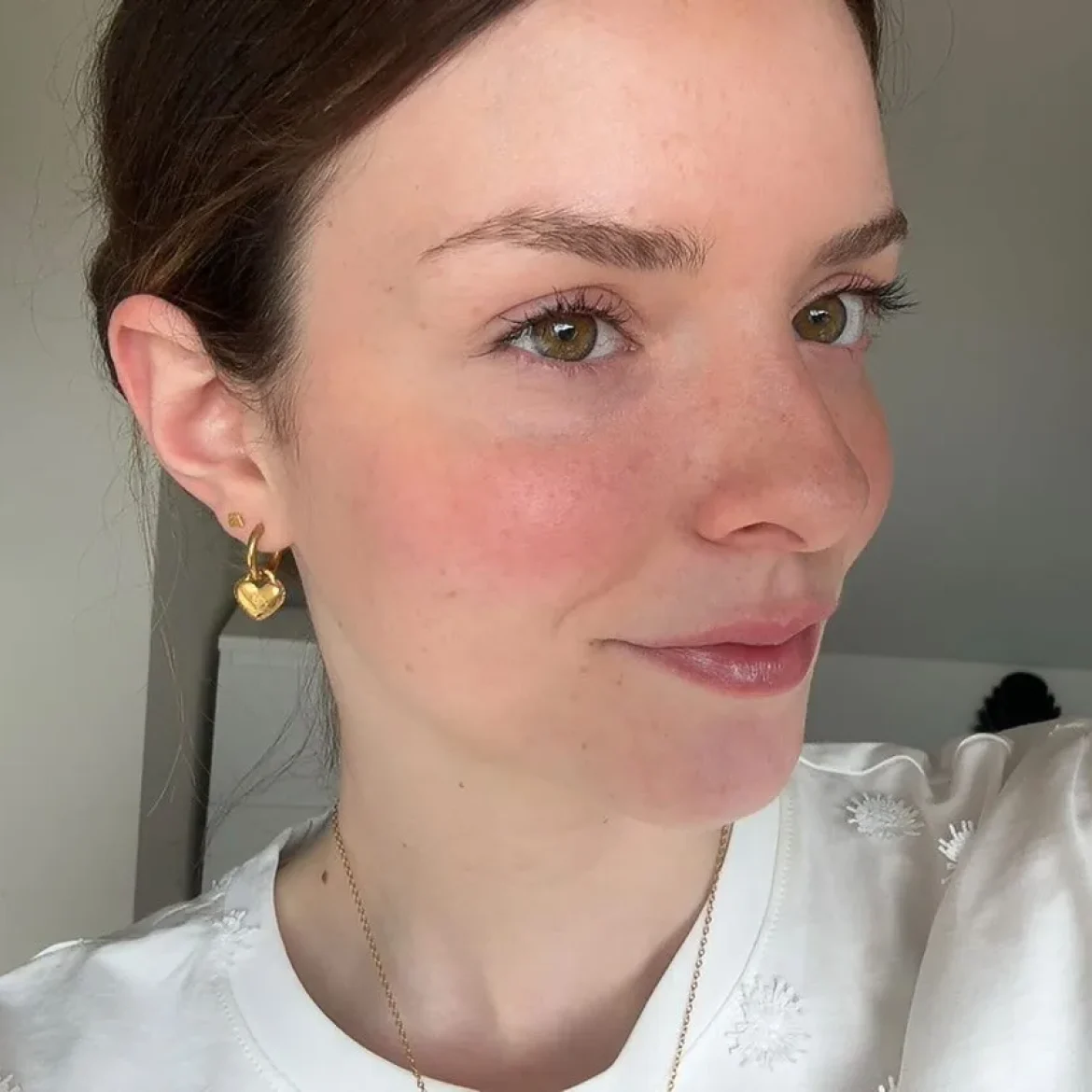 kirsten been amputeren