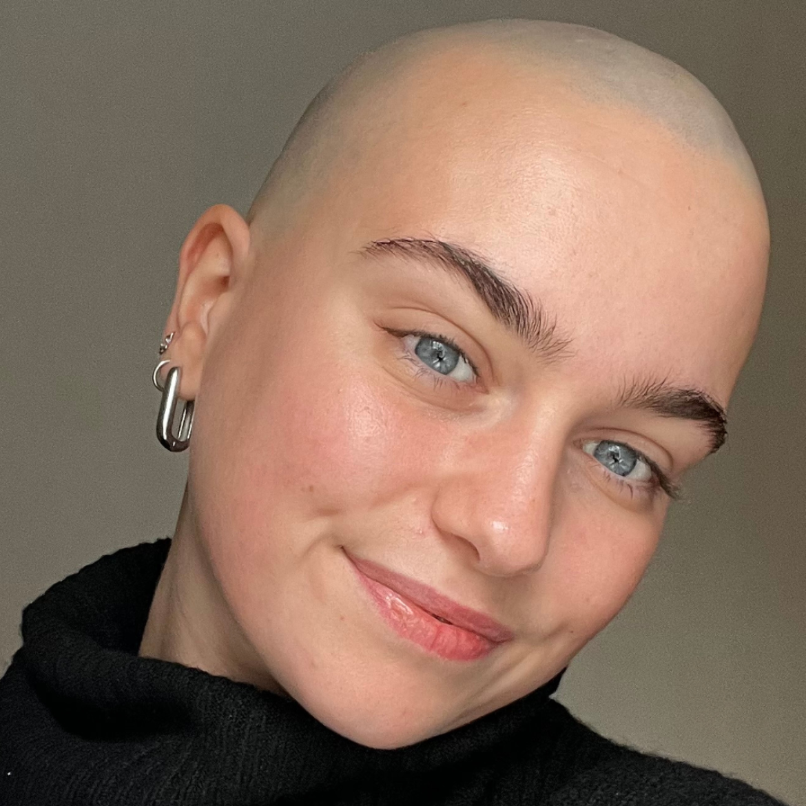 kaal alopecia