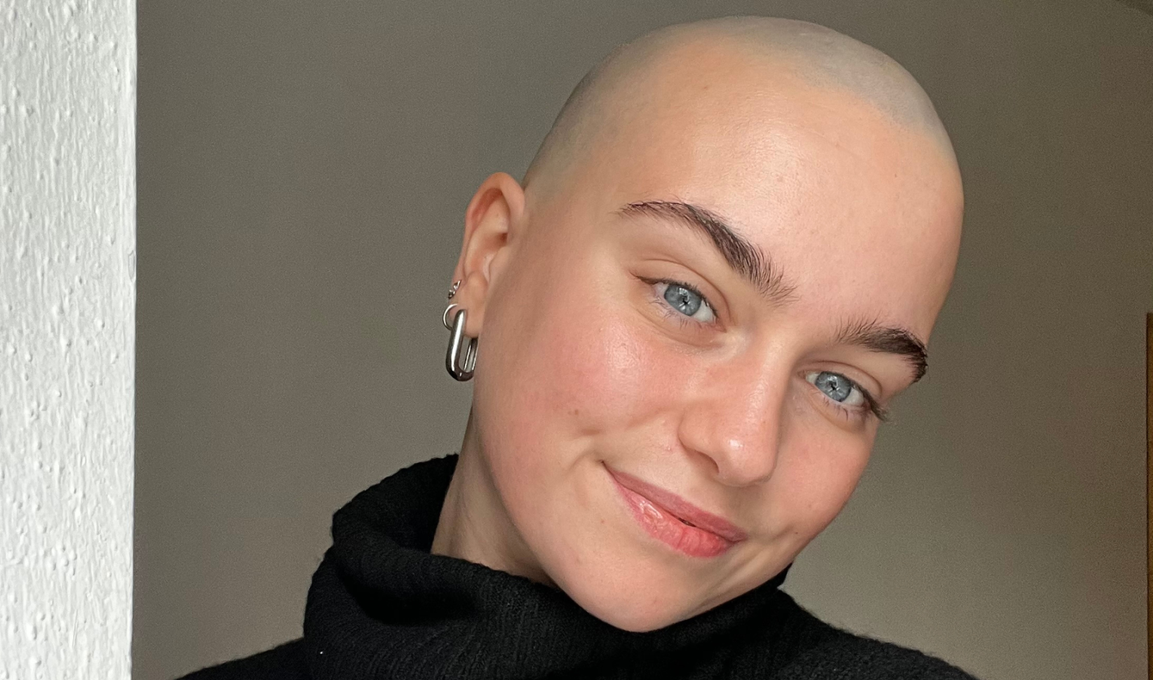 kaal alopecia