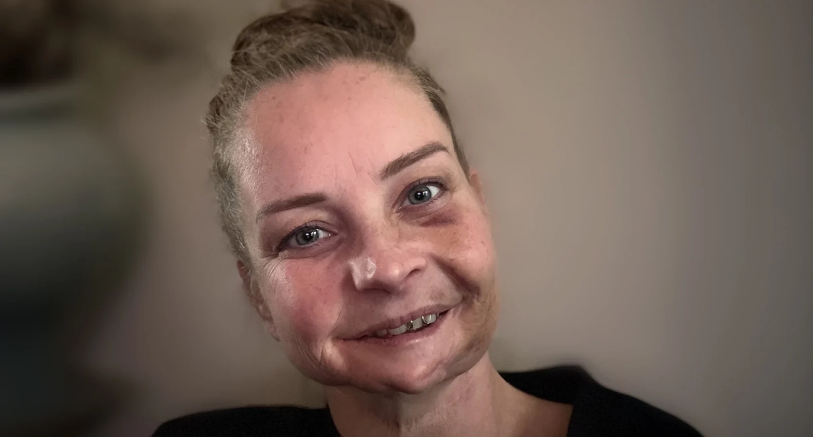 Chantal heeft het Li-Fraumeni syndroom