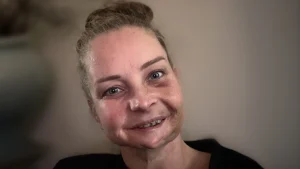 Thumbnail voor Chantal heeft een syndroom waardoor kanker áltijd terugkomt: ’22 kaakoperaties gehad, het is eindeloos sleutelen’