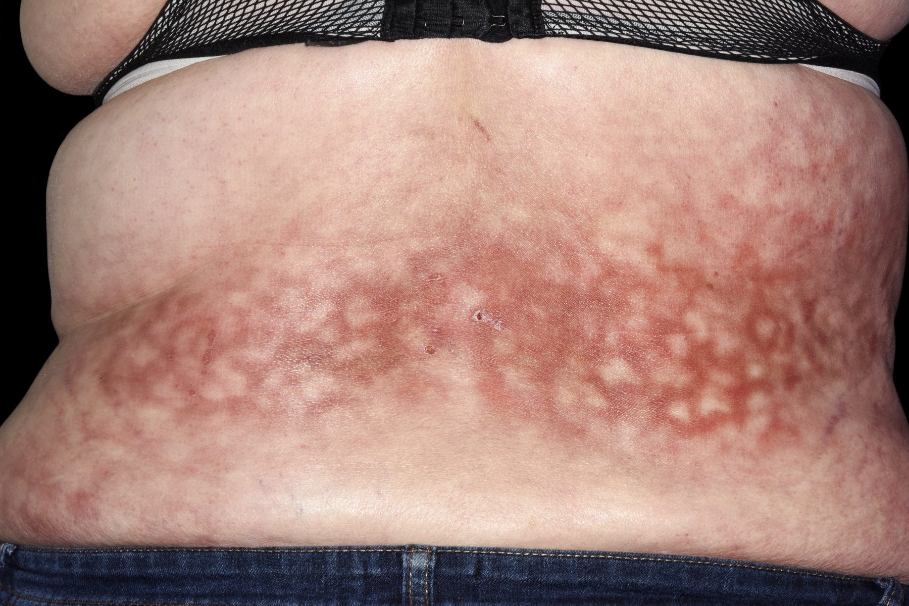 erythema ab igne