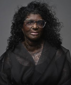 Thumbnail voor Jayan (39) raakte voor 68 procent verbrand: ‘In een psychose heb ik mezelf met benzine overgoten’