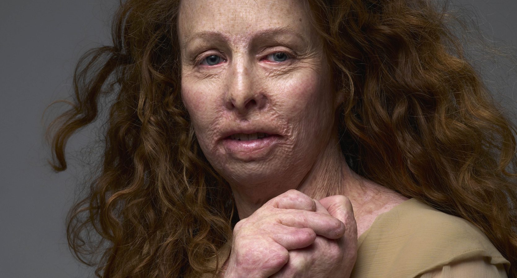 Monique (40) raakte verbrand bij de cafébrand in Volendam: ‘Mijn nylon truitje was in mijn bovenlijf