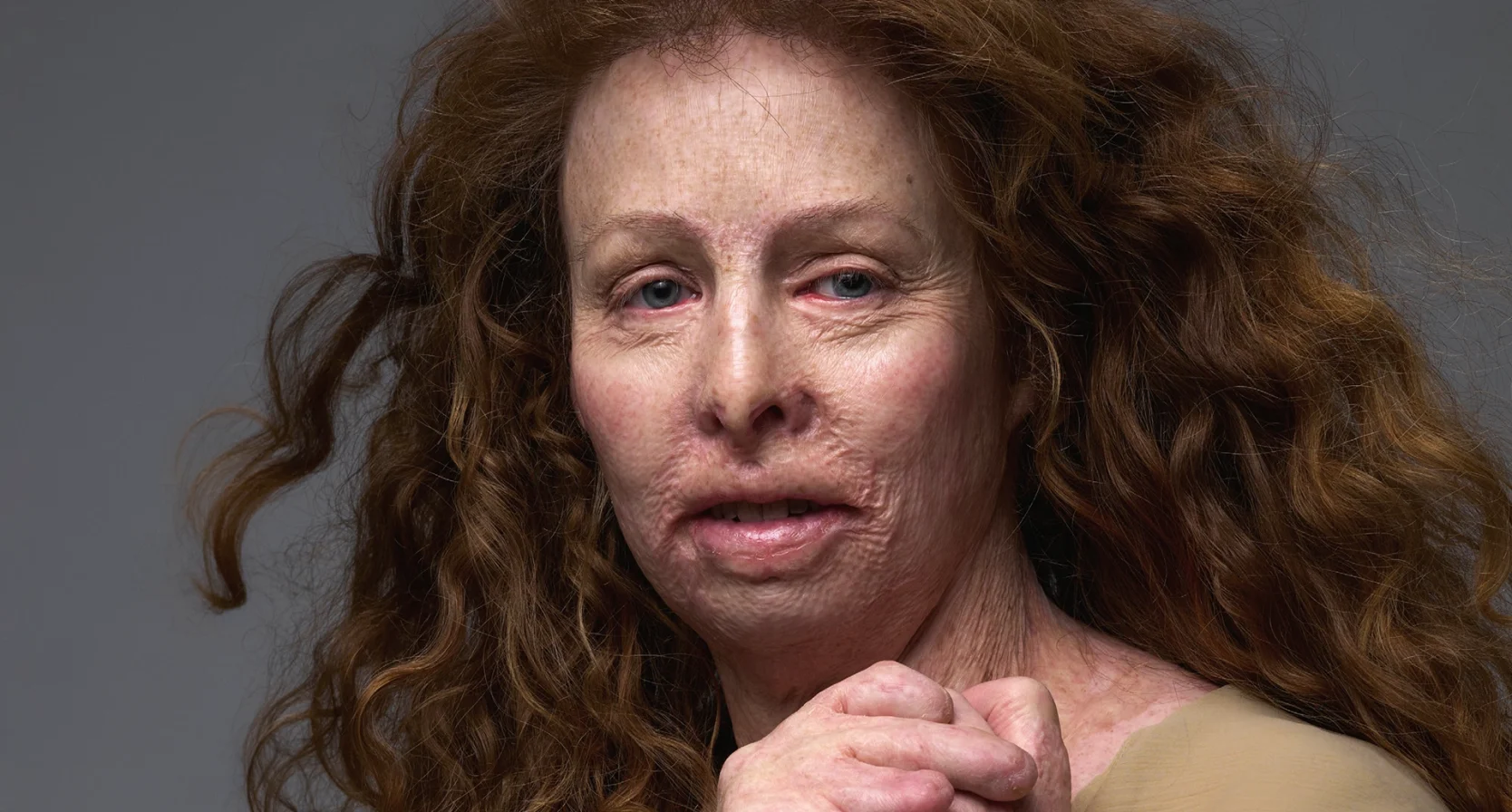 Monique werd verminkt door brand café Volendam