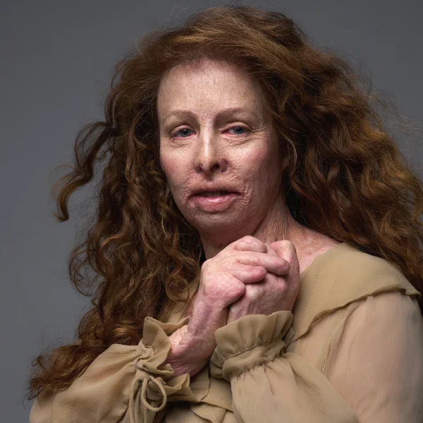 Monique werd verminkt door brand café Volendam