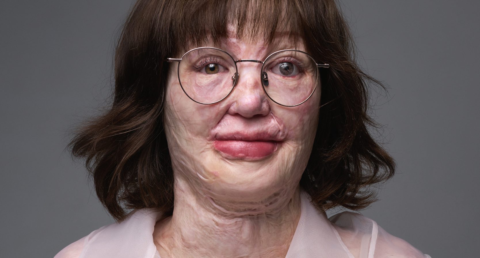 Kim over haar littekens