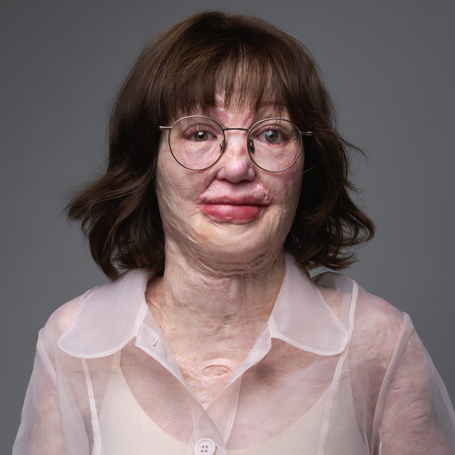 Kim over haar littekens