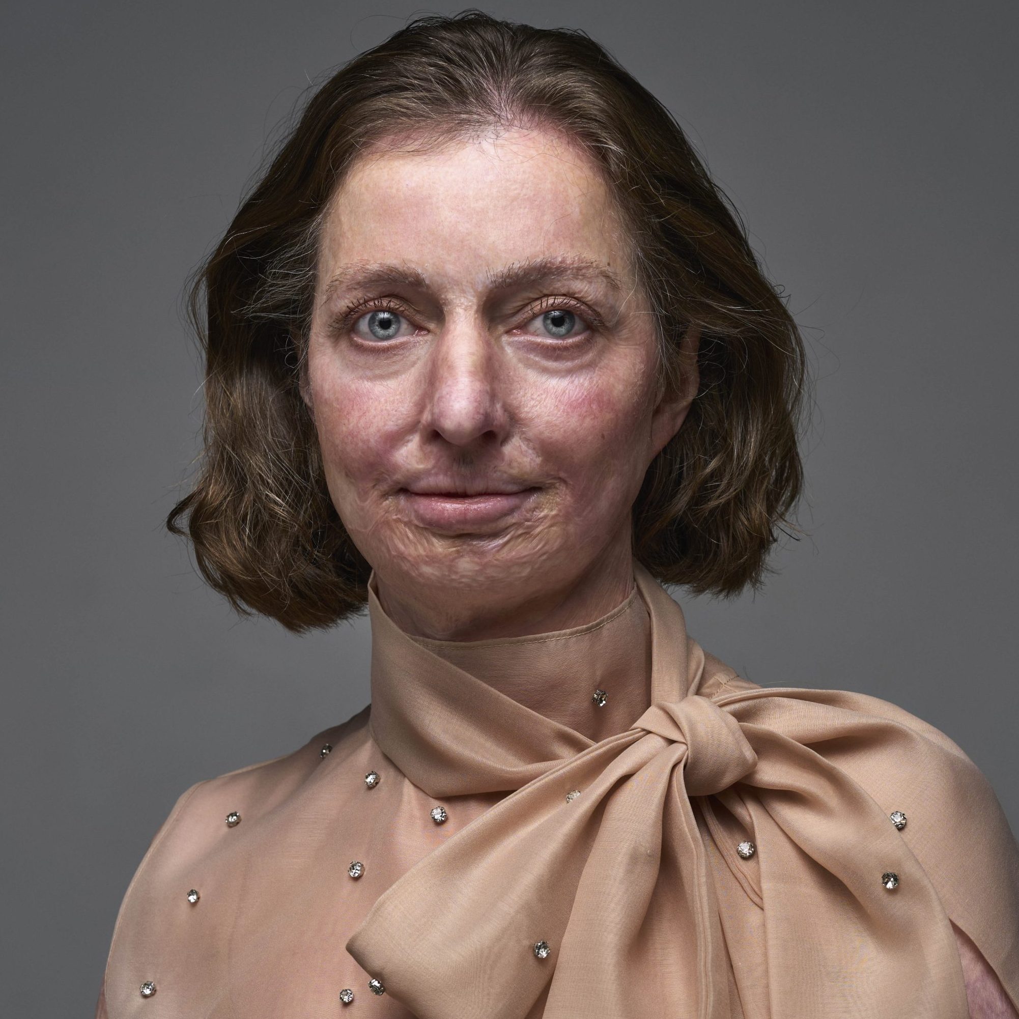 Annemieke (45) raakte als 19-jarige verbrand: ‘Op straat kropen kinderen bang weg’