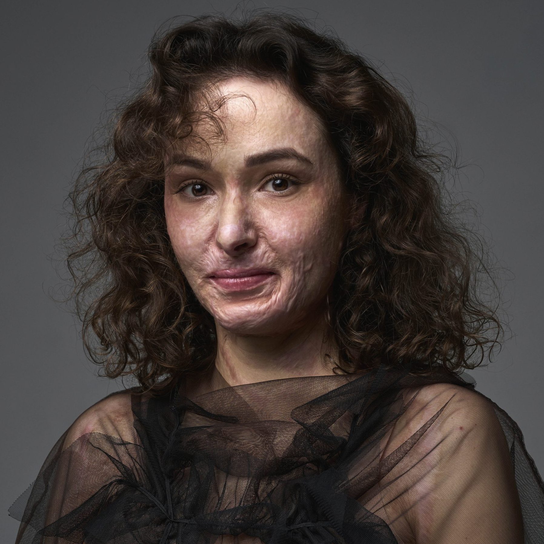 Yuliia (30) raakte verminkt door een brand: ‘Buiten liep ik helemaal ineengedoken’