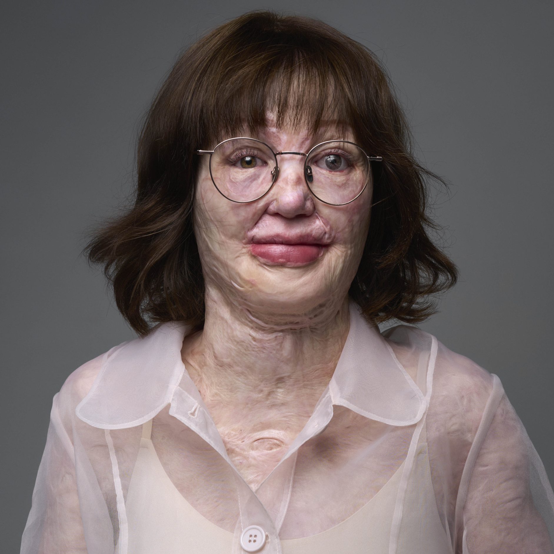 Kim (31) heeft derdegraads brandwonden: ‘Ik zou mijn littekens niet weg willen laten halen’