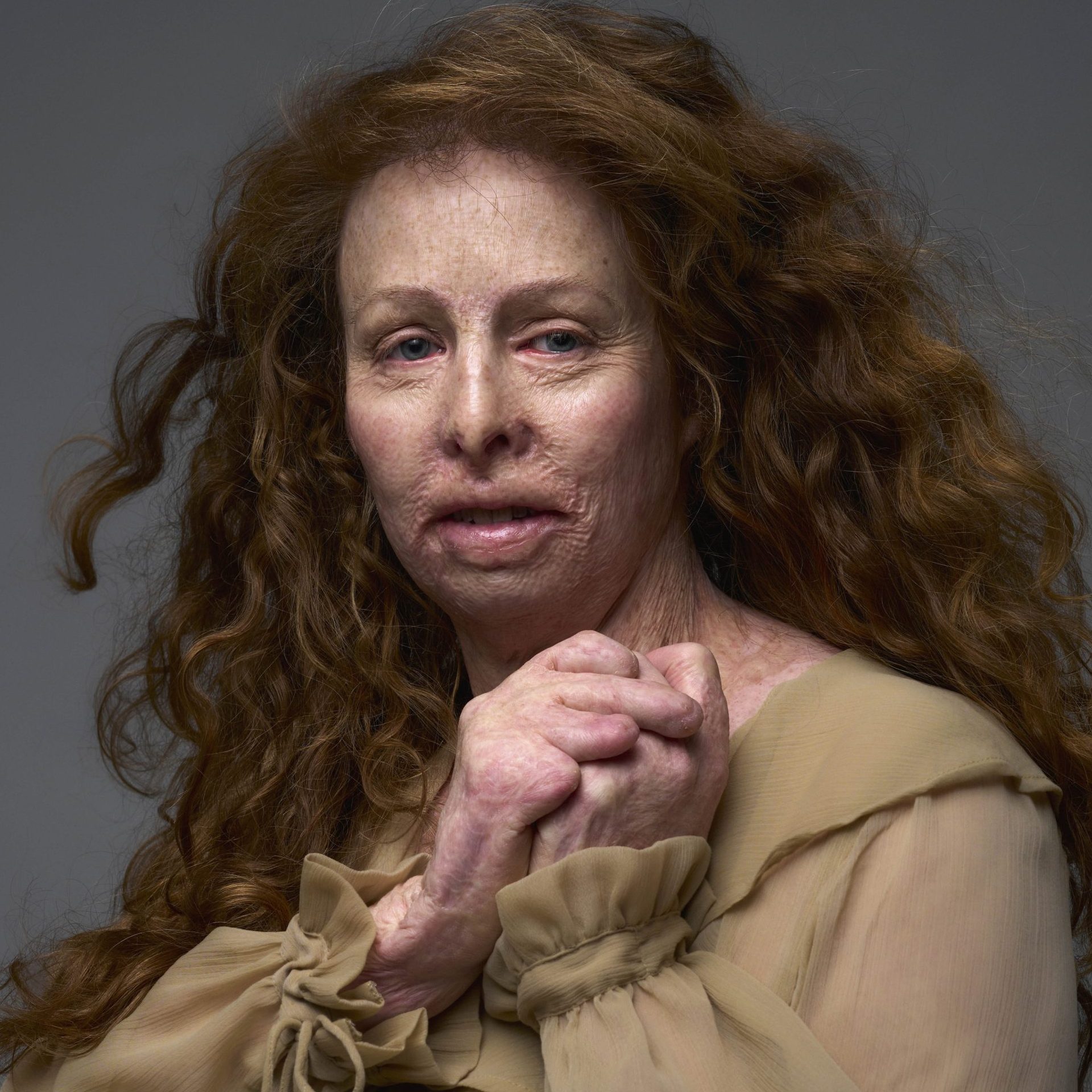 Monique (40) raakte verbrand bij de cafébrand in Volendam: ‘Mijn nylon truitje was in mijn bovenlijf gesmolten’