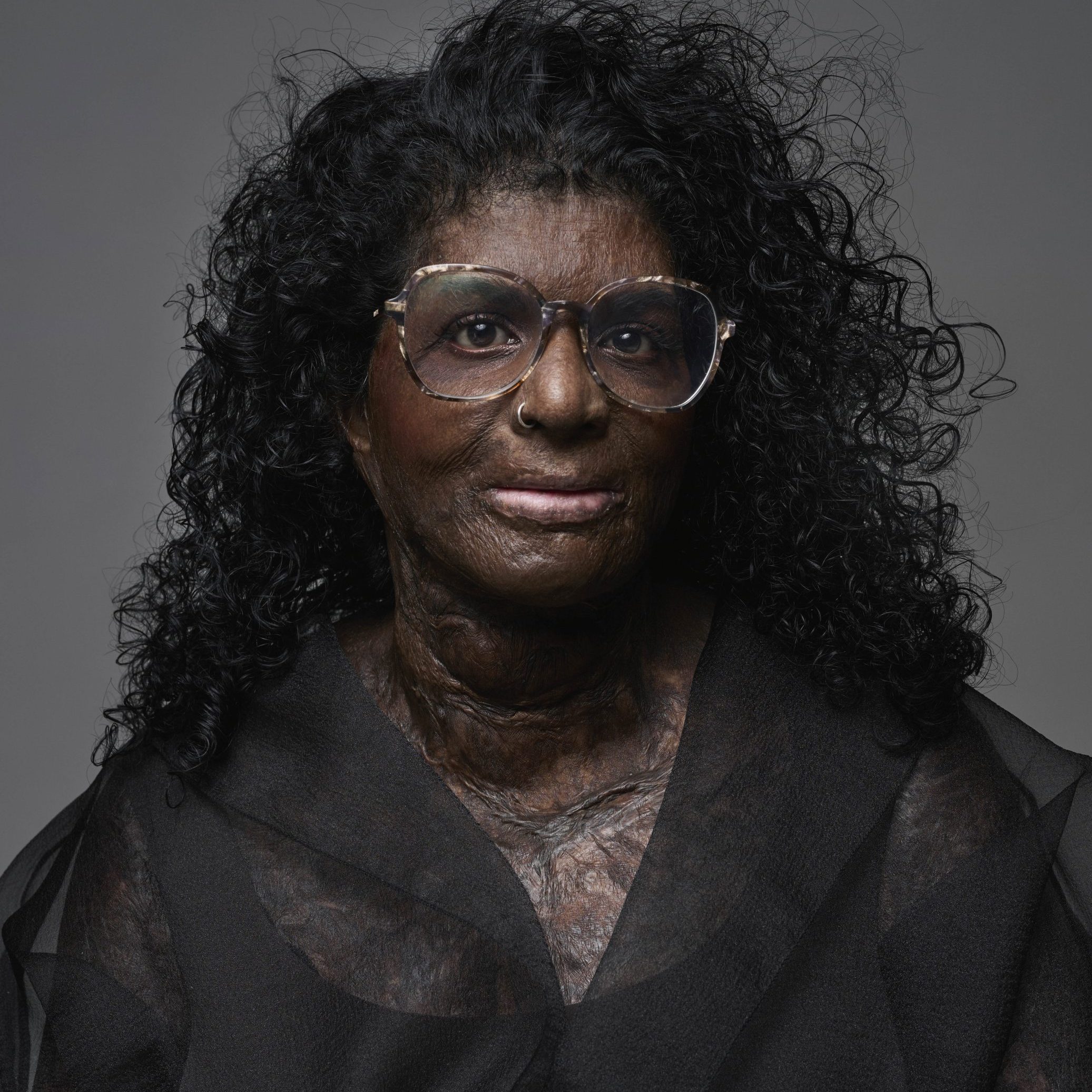 Jayan (39) raakte voor 68 procent verbrand: ‘In een psychose heb ik mezelf met benzine overgoten’