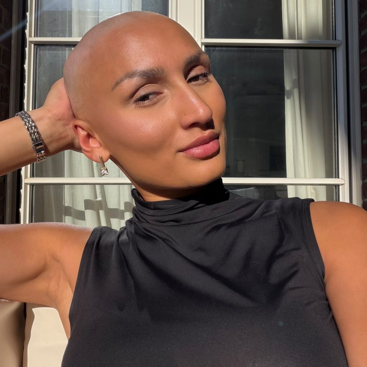 Luna Alopecia