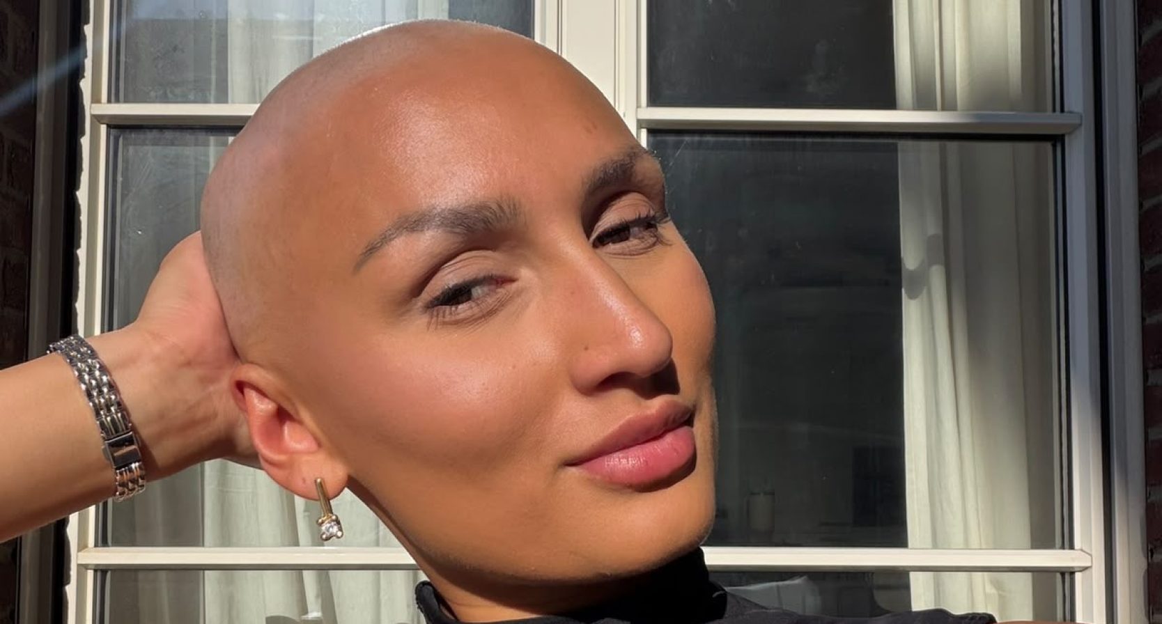 Luna Alopecia