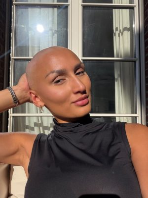 Thumbnail voor Luna heeft alopecia: 'Bijna al mijn haar viel binnen een maand uit'