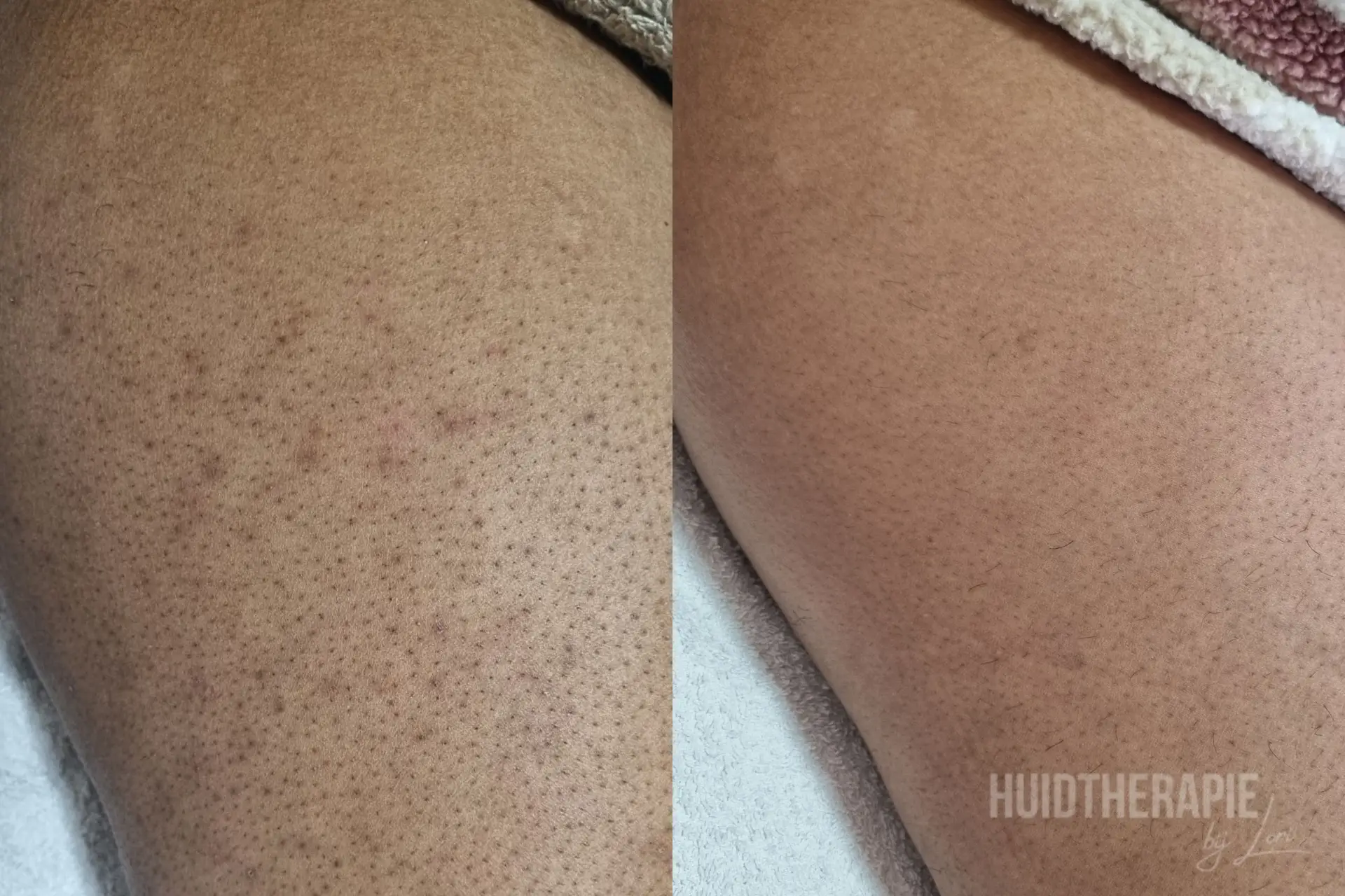 keratosis pilaris voor en na foto na behandeling