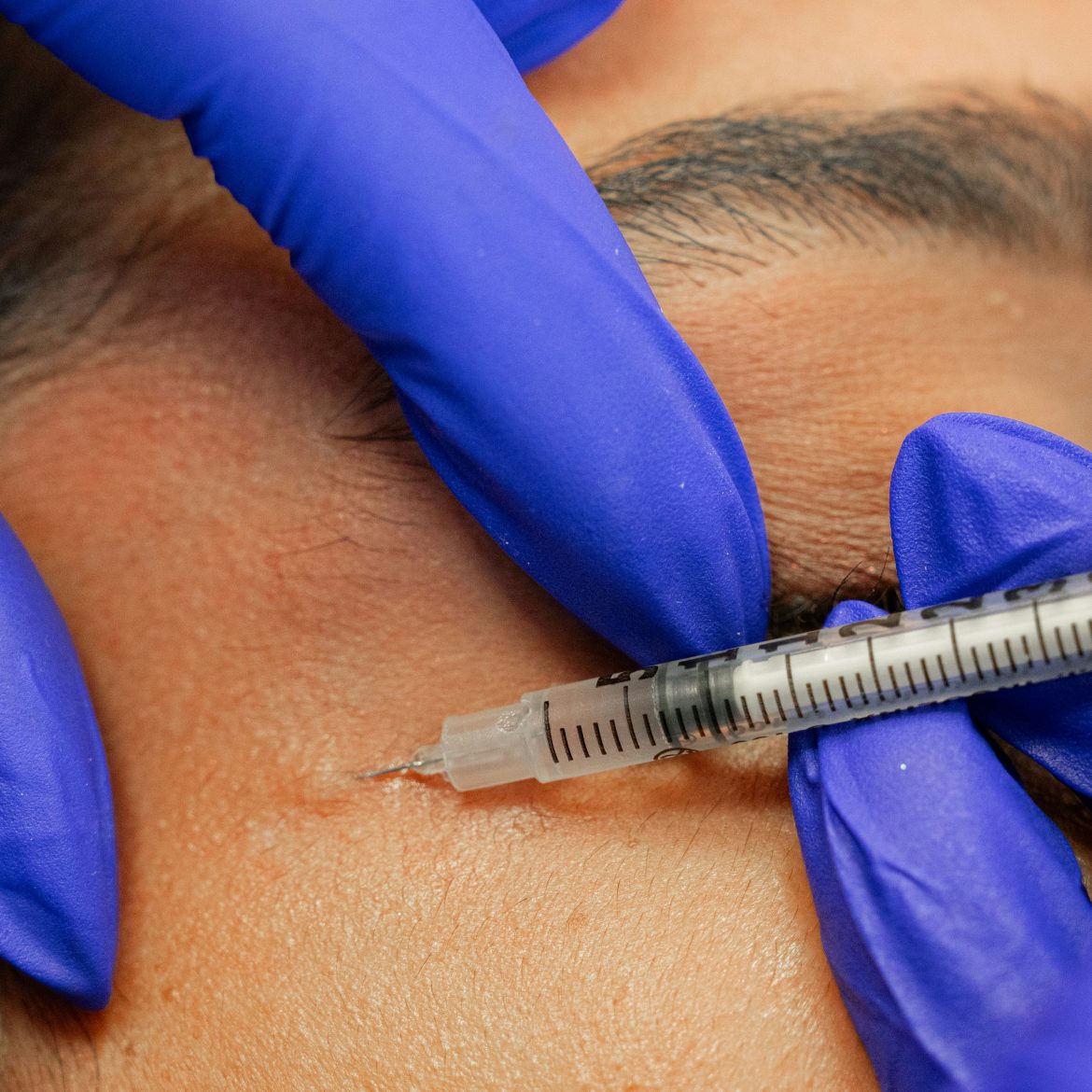 Slecht uitgevoerde cosmetische behandeling meldingen vervijfvoudigd